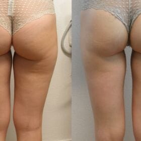 X-Tone - EMS Glutes Stimulator Device photo review
